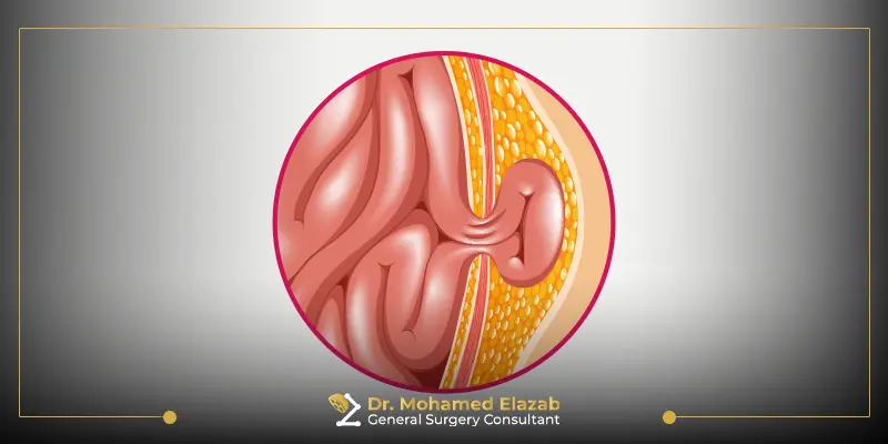 ما هو الناسور العصعصي