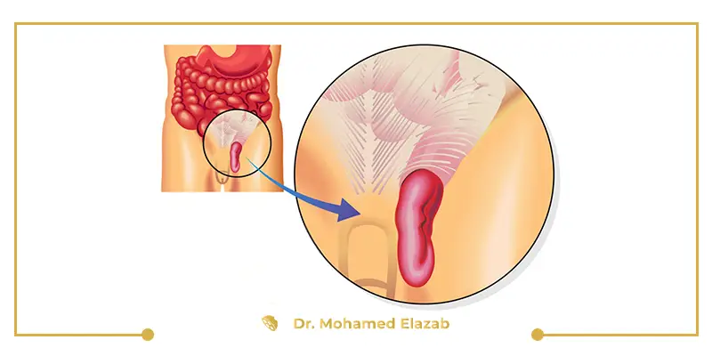 علاج فتق الخصيةبدون جراحة
