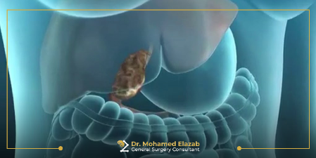 مدة عملية استئصال المرارة بالمنظار