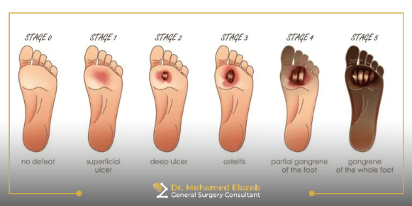 مراحل القدم السكري