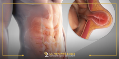 الفتق الاربي عند الرجال