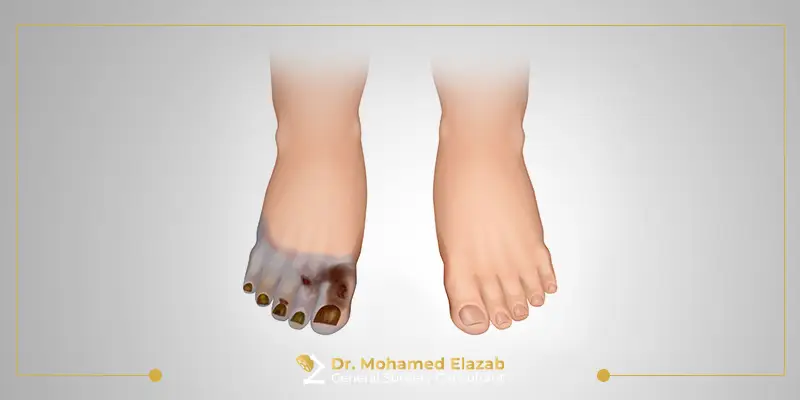 غرغرينا القدم السكري