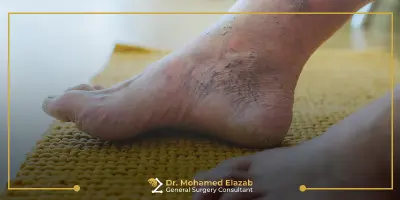 طريقة فحص القدم السكرية