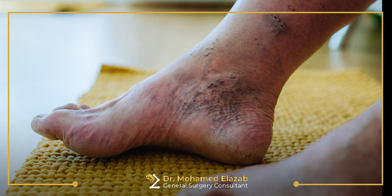 افضل طرق علاج القدم السكري