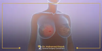 أورام الثدي الحميدة وأعراضها